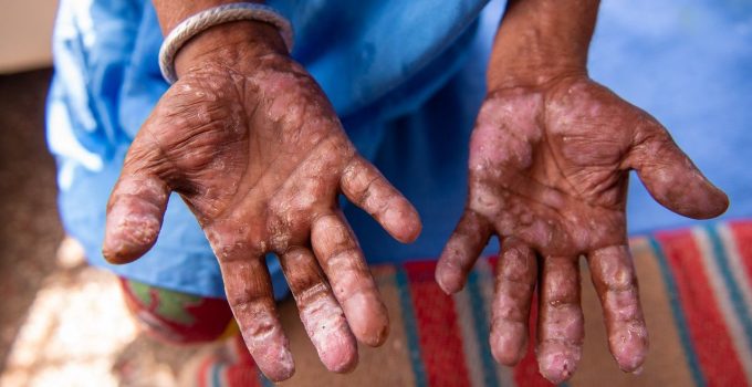 “Cüzzam Nadir de Olsa, Hâlâ Türkiye’de Görülüyor”